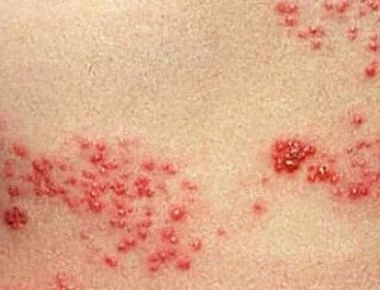 Έρπης ζωστήρας: Θεραπεία και συμπτώματα εκτός από σημάδια στο σώμα